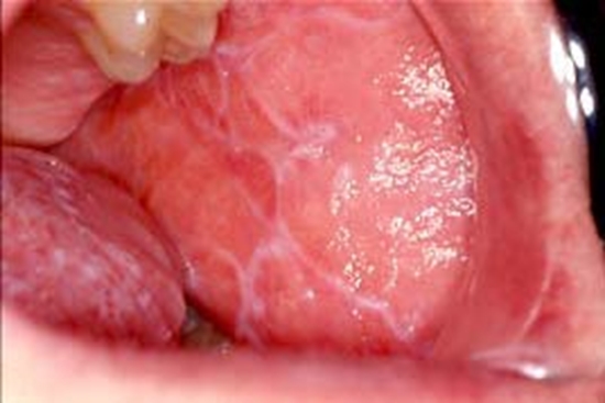 oral lichen planus 1 